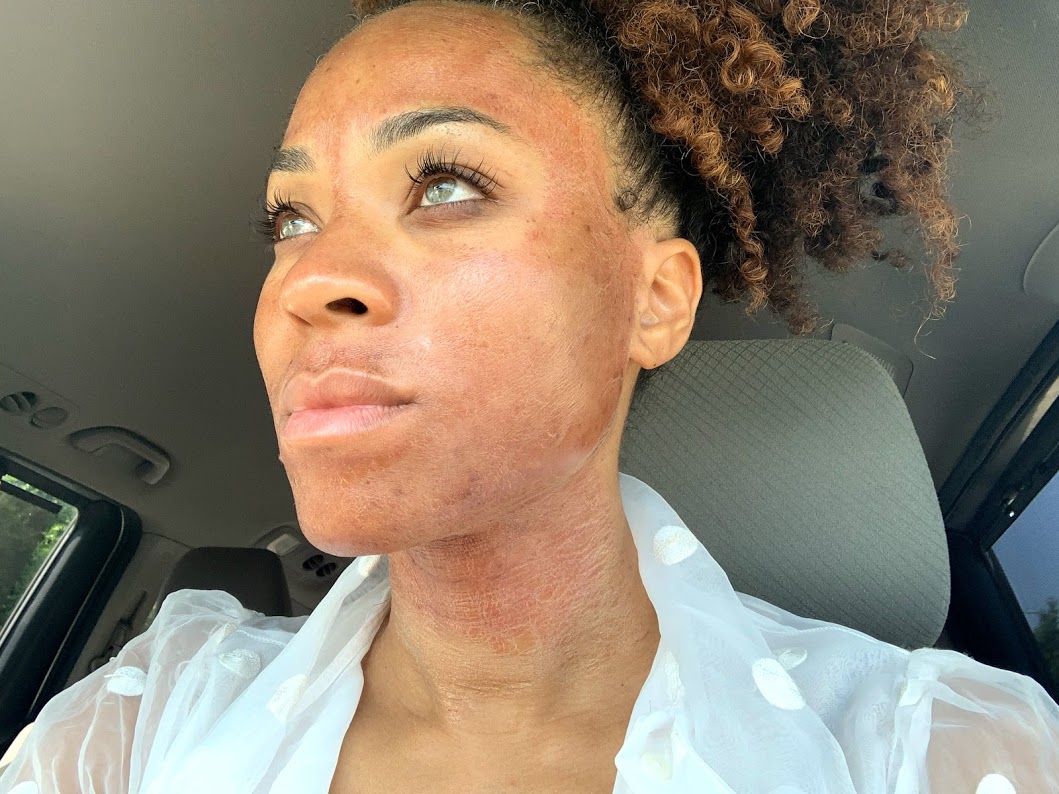 Microneedling First Impressions