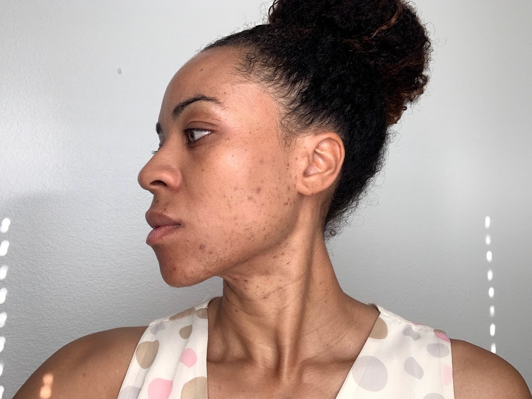 my honest review of microneedling 