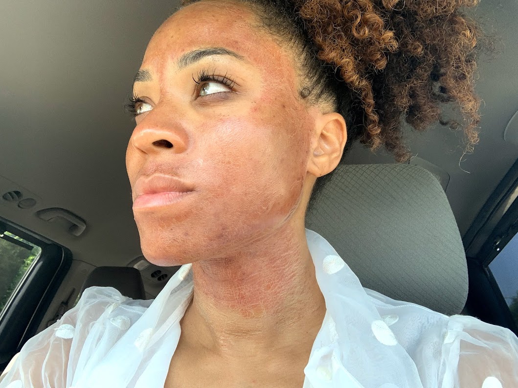 microneedling first impressions